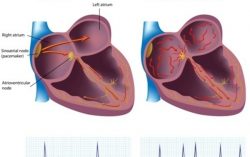 Atrial Fibrillation: A very common cardiac problem
