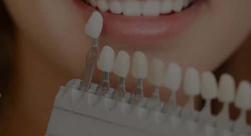 Porcelain-Veneers-in-Florida-Cosmetic-Dentistry-North-River-Dental