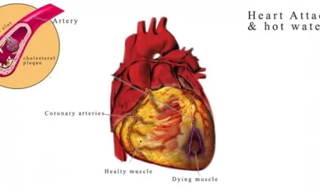 Heart Attacks And Drinking Warm Water