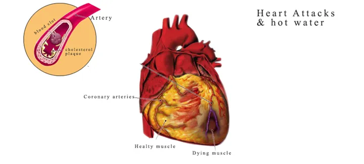 Heart Attacks And Drinking Warm Water
