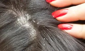 Home Remedies To Get Rid Of Dandruff