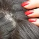Home Remedies To Get Rid Of Dandruff