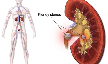 What Are Kidney Stones