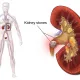 What Are Kidney Stones