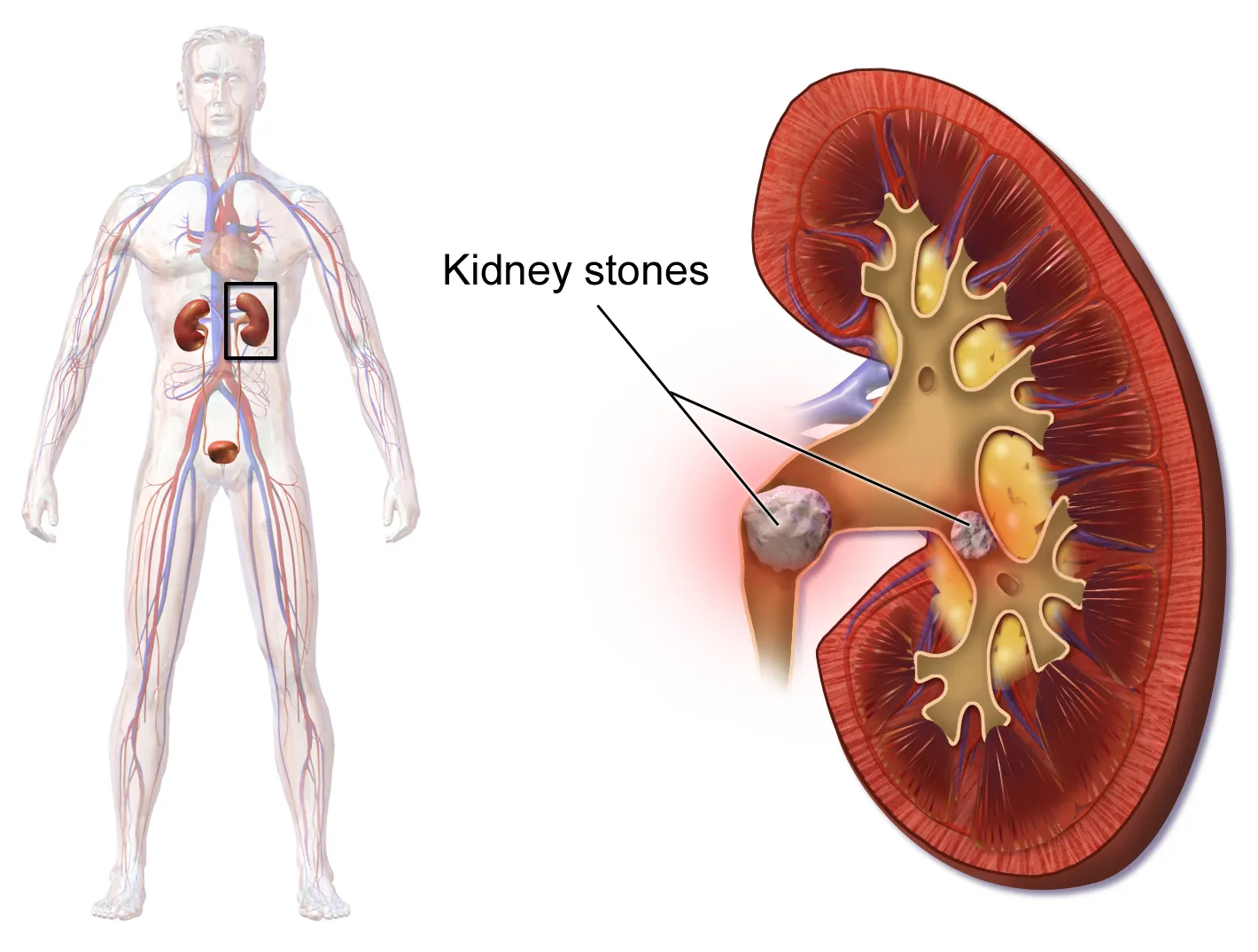 What Are Kidney Stones