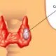 Thyroid Cancer