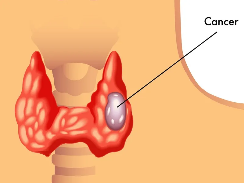 Thyroid Cancer
