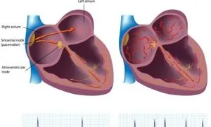 Atrial Fibrillation
