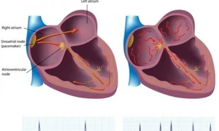 Atrial Fibrillation