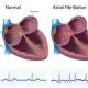 Atrial Fibrillation