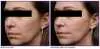 c067a3246407375088587609dae05714_Facial2520Tightening2520Before2520and2520After25205.jpg.ico