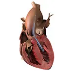 Impella 5.5 With SmartAssist