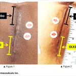 OLX10010 For Hypertrophic Scar Treatment 28Image OliX Pharmaceuticals Inc.29
