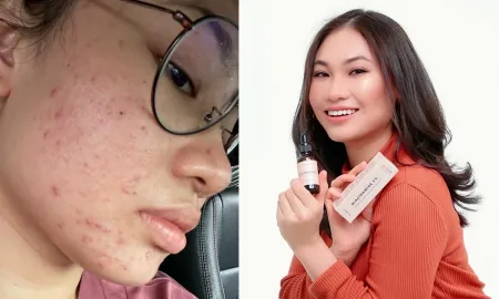 Before And After Of Adibah Mazla