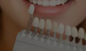 Porcelain Veneers In Florida Cosmetic Dentistry North River Dental