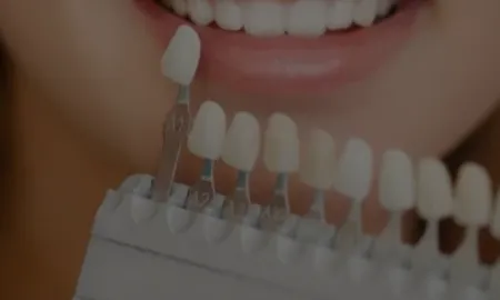 Porcelain Veneers In Florida Cosmetic Dentistry North River Dental