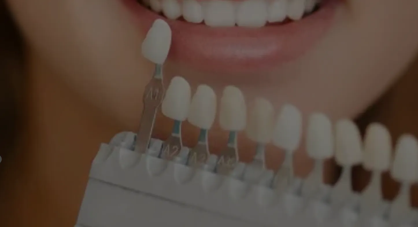 Porcelain-Veneers-in-Florida-Cosmetic-Dentistry-North-River-Dental