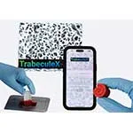 TrabeculeX Continuum By Xenco Medical