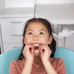 Invisalign_Palatal_Expander_System-1