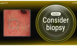 Ast Cancer01 100per E28093 2