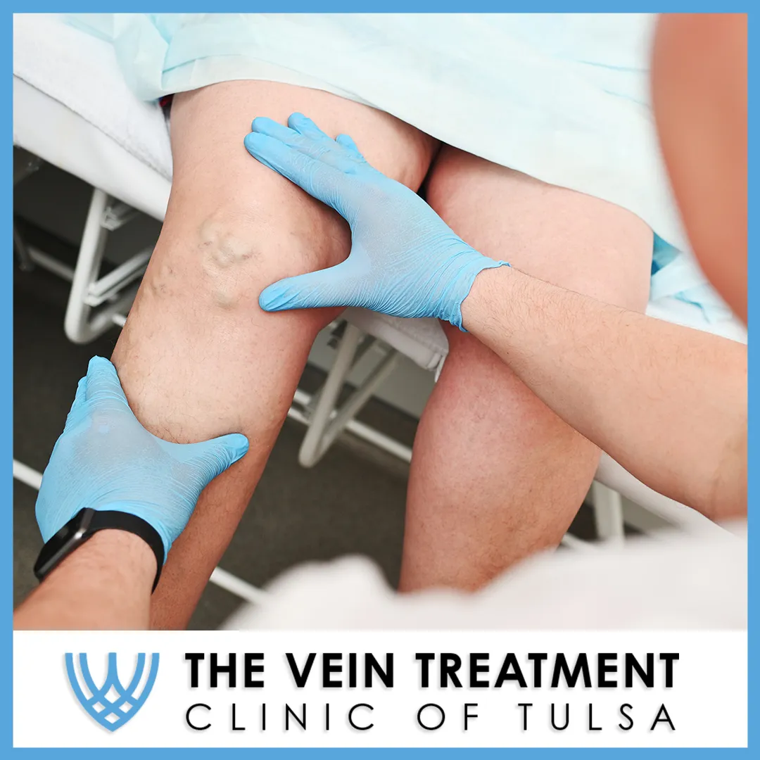 Leg Swelling